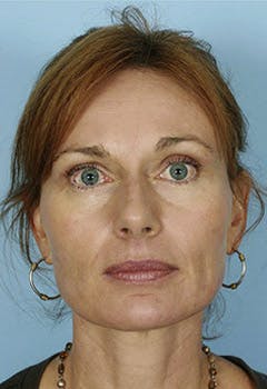 full face fat transfer before front in texas full face fat transfer before front in texas