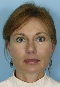 full face fat transfer after front in texas full face fat transfer after front in texas