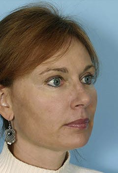 full face fat transfer after oblique in texas full face fat transfer after oblique in texas