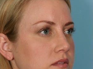 Fig. 1. Young woman demonstrating a full brow fat pad with a soft superior orbital rim and plump support for the brow.