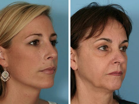 Fig. 2. Photos comparing youthful lower eyelid complex (left) with short-appearing lower eyelid and smooth transition between the lower eyelid and cheek and the typical-aged lower eyelid cheek complex (right) with a long-appearing lower eyelid and orbital groove.