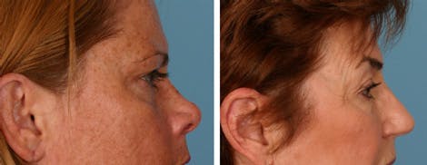 Fig. 6. Comparison of lateral views of patient (left) who lacks steatoblepharon and underwent only a fat transfer with patient (right) with a sufficient steatoblepharon to warrant a transconjunctival blepharoplasty and fat transfer.