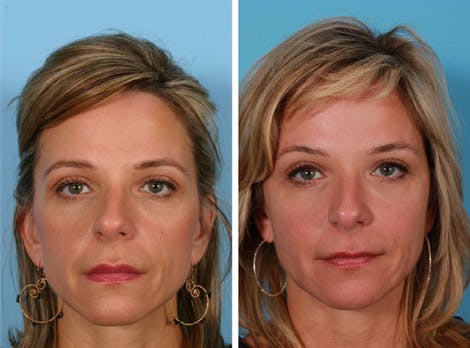 Fig. 7.a . 44-year-old woman, frontal (A) and oblique (B) photos before and after 3 treatments, 2 vials each, PLLA to temples, cheeks, marionette, and prejowl sulcus. Patient had overprojecting maxilla to malar area.