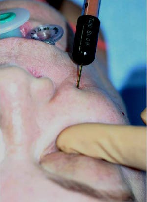 Fig. 11. The lateral canthus is approached from the crow's feet area; 1 mL to 2 mL is blended into the lateral inferior orbital rim injection and toward the superior orbital rim.