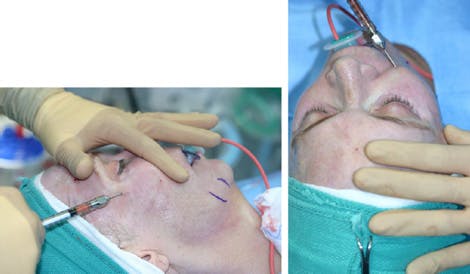 Fig. 13. The anterior cheek is approached from the crow's feet entry site. (left) The nondominant index finger is laid against the bulge of the nasolabial fold and fat is injected in the deep subcutaneous and intramuscular plane all along this area. The lateral cheek is then approached from anteriorly (right) building on the lateral edge of the anterior cheek fat deposit to form a tapered teardrop.