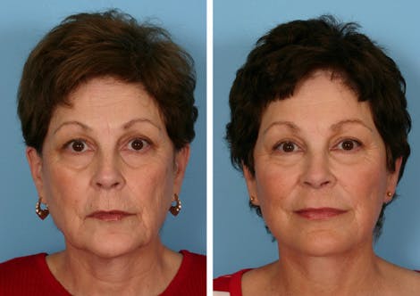 full face fat transfer before - TX