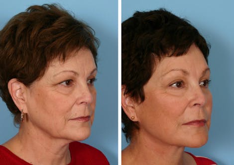 full face fat transfer after - TX