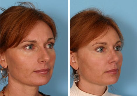 full face fat transfer after oblique - TX