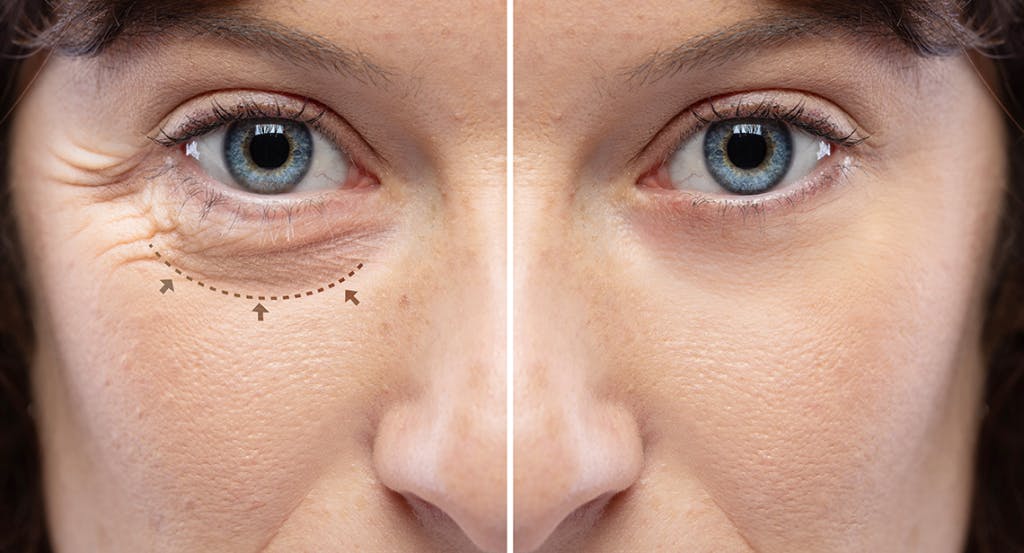 Eyelid surgery before and after example