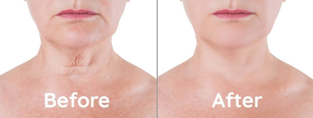 before and after a neck lift procedure