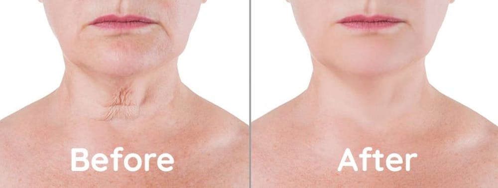before and after a neck lift procedure