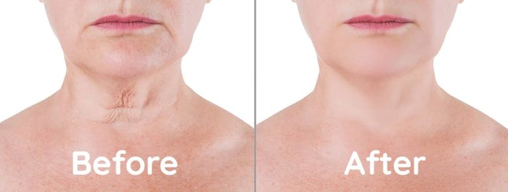 Before and after a neck lift procedure before and after a neck lift procedure