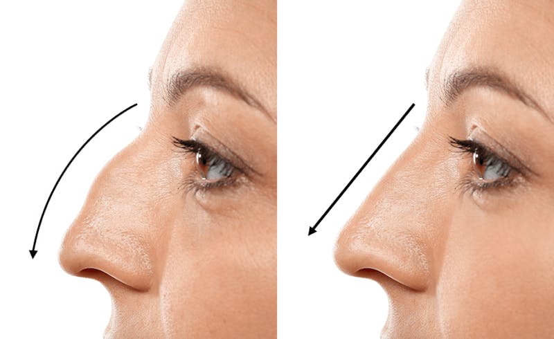rhinoplasty results