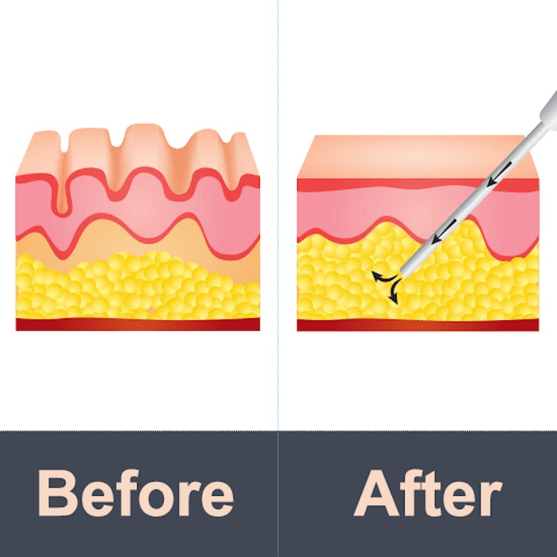 fat transfer infographic