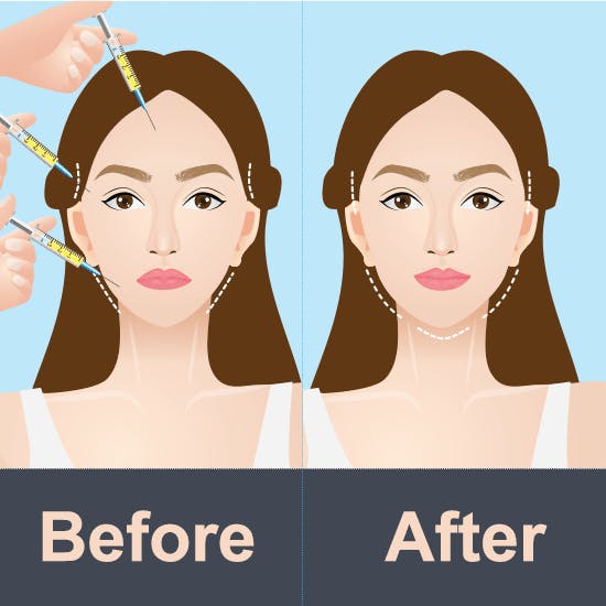 Woman fat transfer before after Woman fat transfer before after
