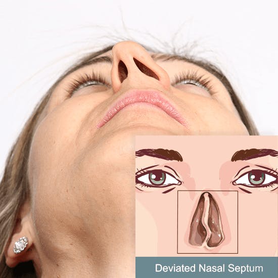 Deviated Nasal Septum Woman with deviated septum. Graphic example on right corner.