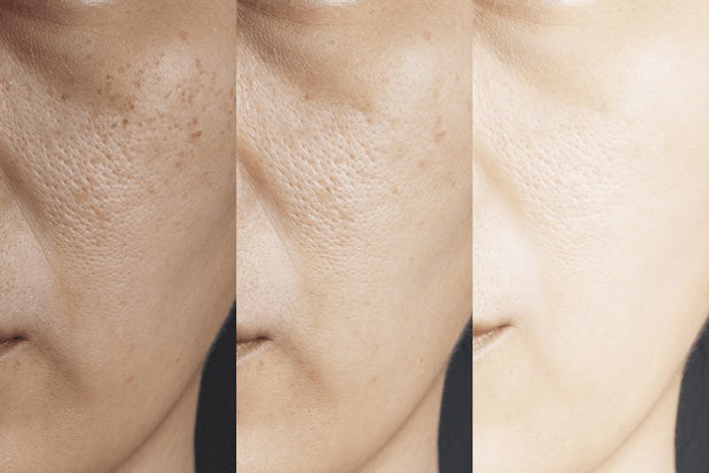 Retin-A and Hydroquinone results