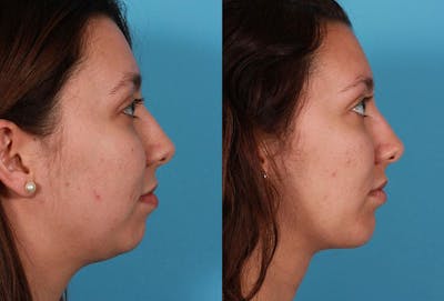 Chin and Cheek Augmentation Before & After Gallery - Patient 427901 - Image 1