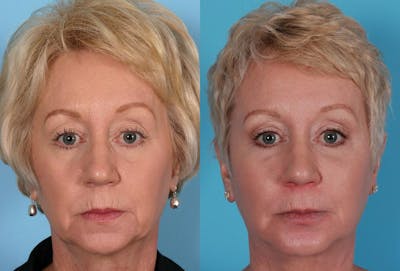 Chin and Cheek Augmentation Before & After Gallery - Patient 413096 - Image 1