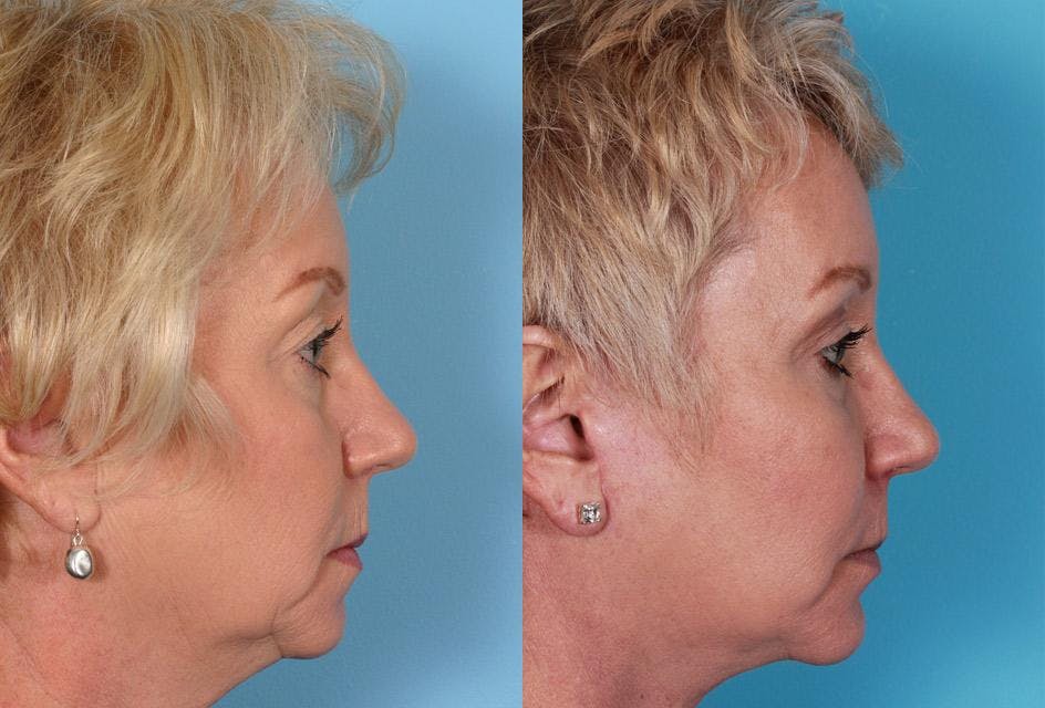 Chin and Cheek Augmentation Before & After Gallery - Patient 413096 - Image 3