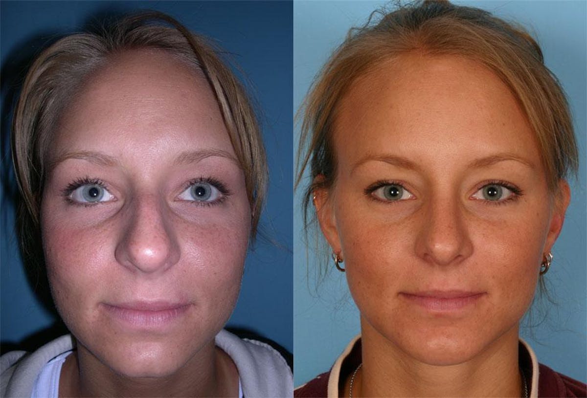 Chin and Cheek Augmentation Before & After Gallery - Patient 116983 - Image 1