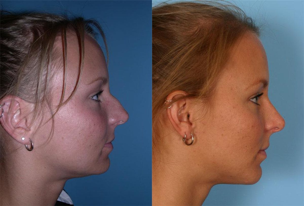 Chin and Cheek Augmentation Before & After Gallery - Patient 116983 - Image 2