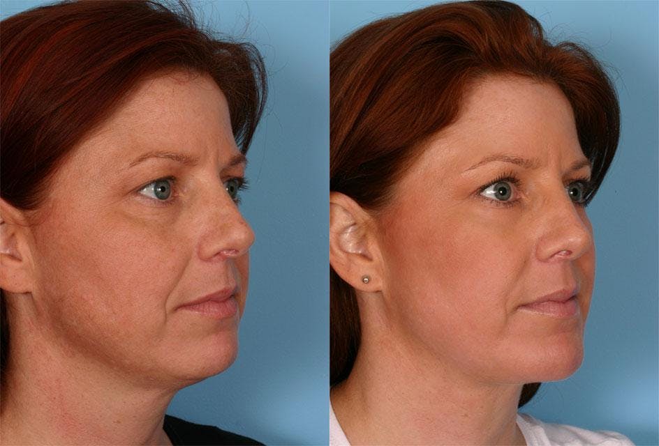 Chin and Cheek Augmentation Before & After Gallery - Patient 187807 - Image 2