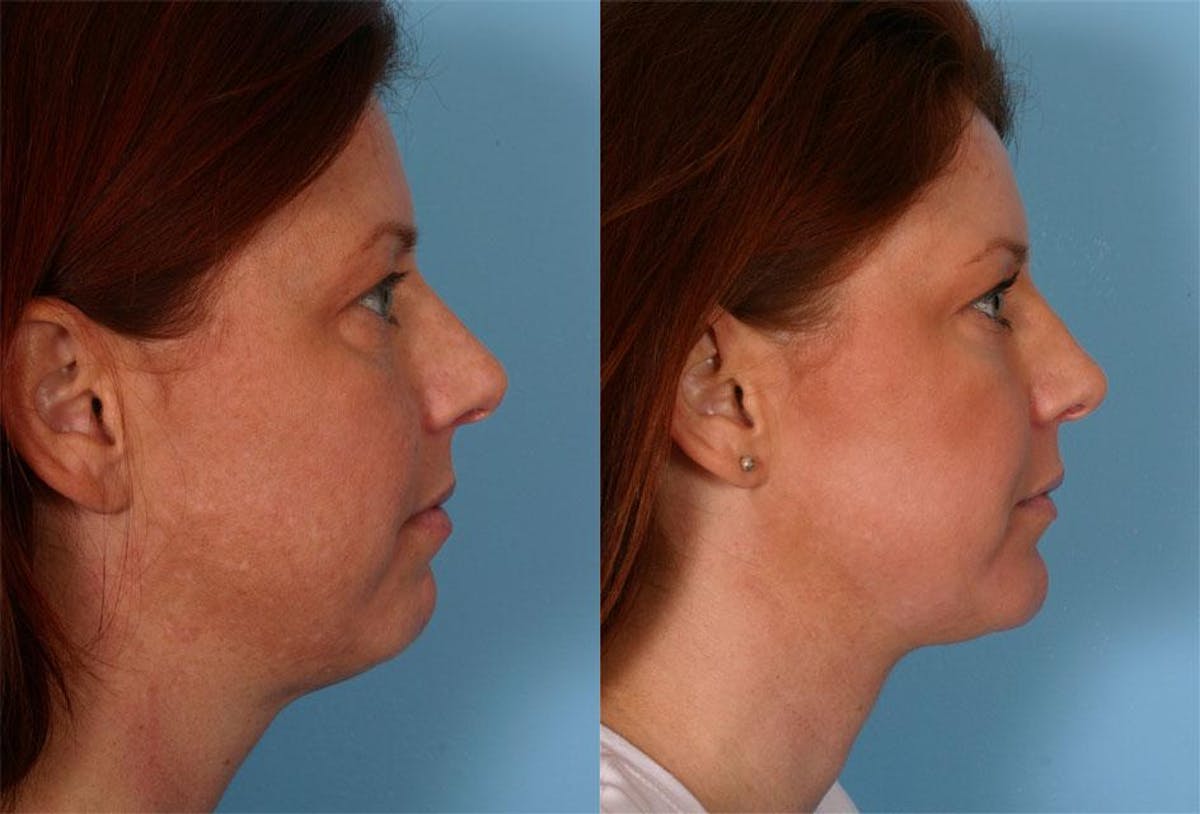 Chin and Cheek Augmentation Before & After Gallery - Patient 187807 - Image 3