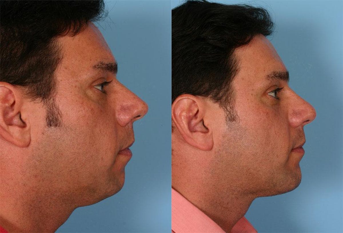 Chin and Cheek Augmentation Before & After Gallery - Patient 420478 - Image 2