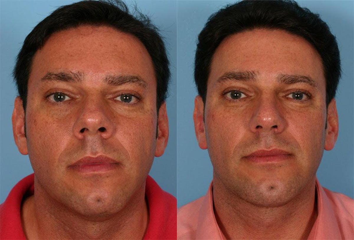 Chin and Cheek Augmentation Before & After Gallery - Patient 420478 - Image 3