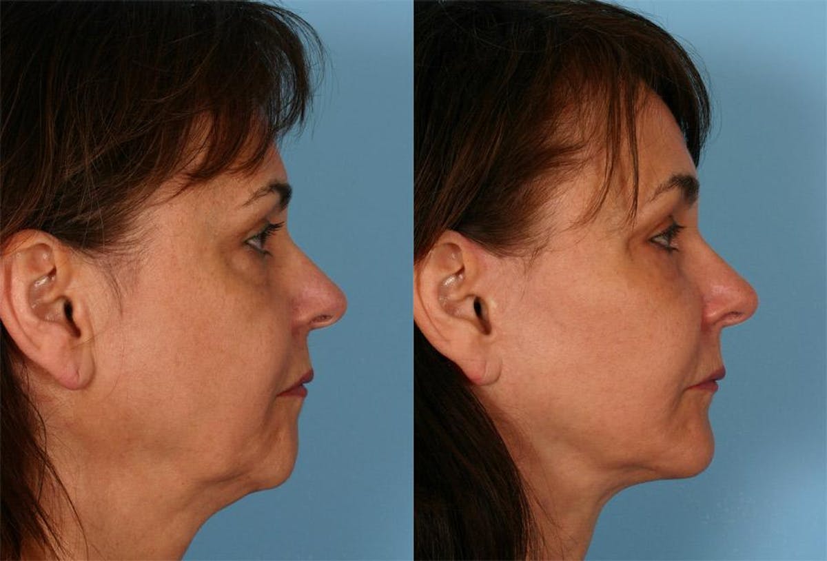 Chin and Cheek Augmentation Before & After Gallery - Patient 770639 - Image 3