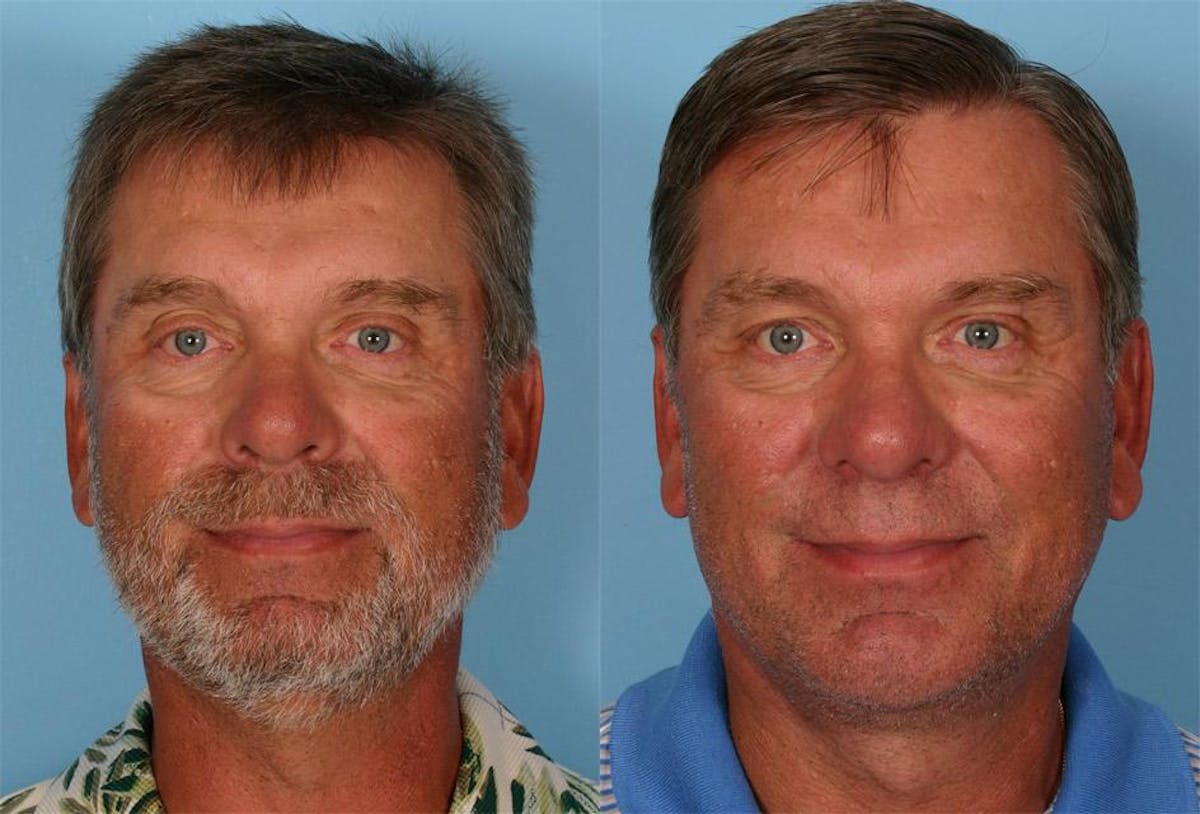 Chin and Cheek Augmentation Before & After Gallery - Patient 282944 - Image 1