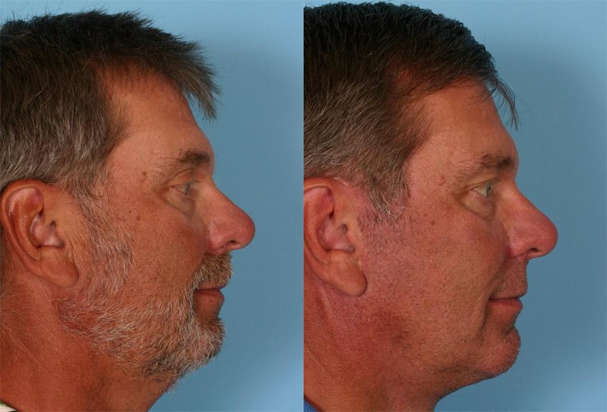 Chin and Cheek Augmentation Before & After Gallery - Patient 282944 - Image 2