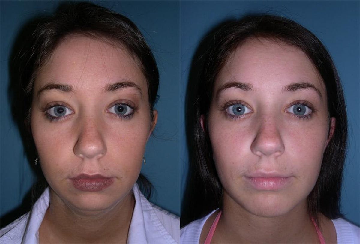 Chin and Cheek Augmentation Before & After Gallery - Patient 411957 - Image 1