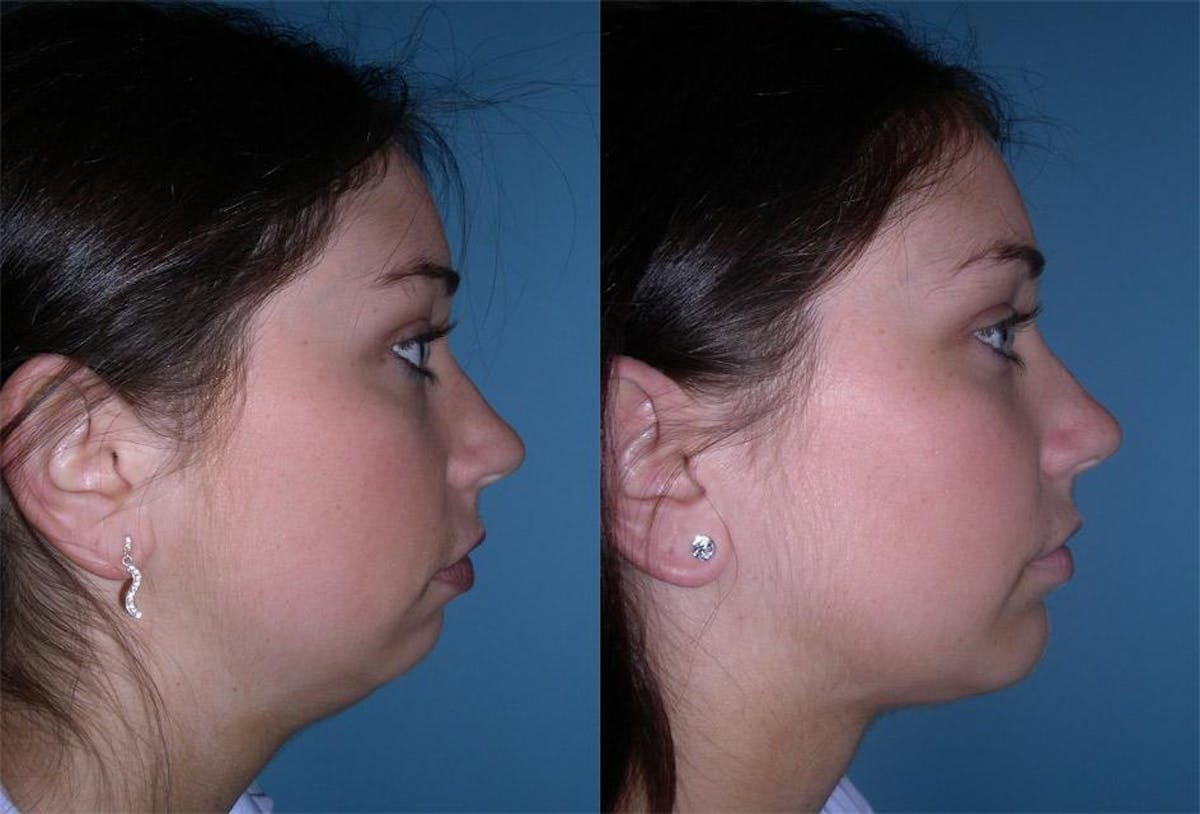 Chin and Cheek Augmentation Before & After Gallery - Patient 411957 - Image 2