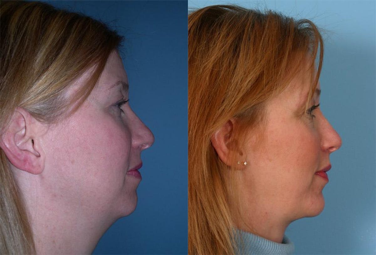 Chin and Cheek Augmentation Before & After Gallery - Patient 334585 - Image 1