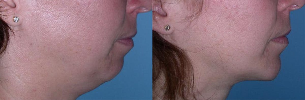 Chin and Cheek Augmentation Before & After Gallery - Patient 729215 - Image 1
