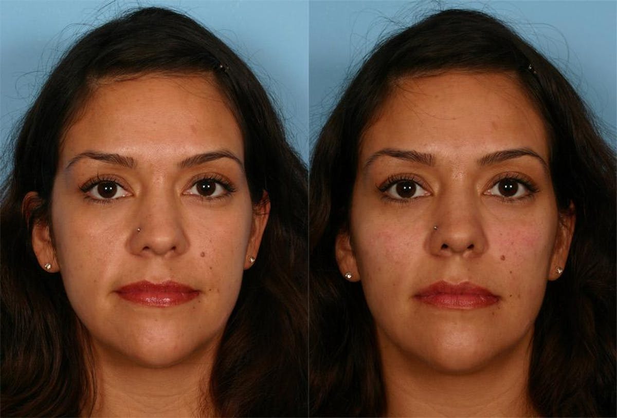 Chin and Cheek Augmentation Before & After Gallery - Patient 687329 - Image 1