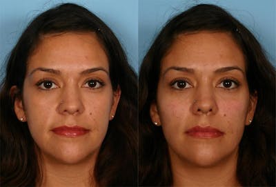 Chin and Cheek Augmentation Before & After Gallery - Patient 687329 - Image 1