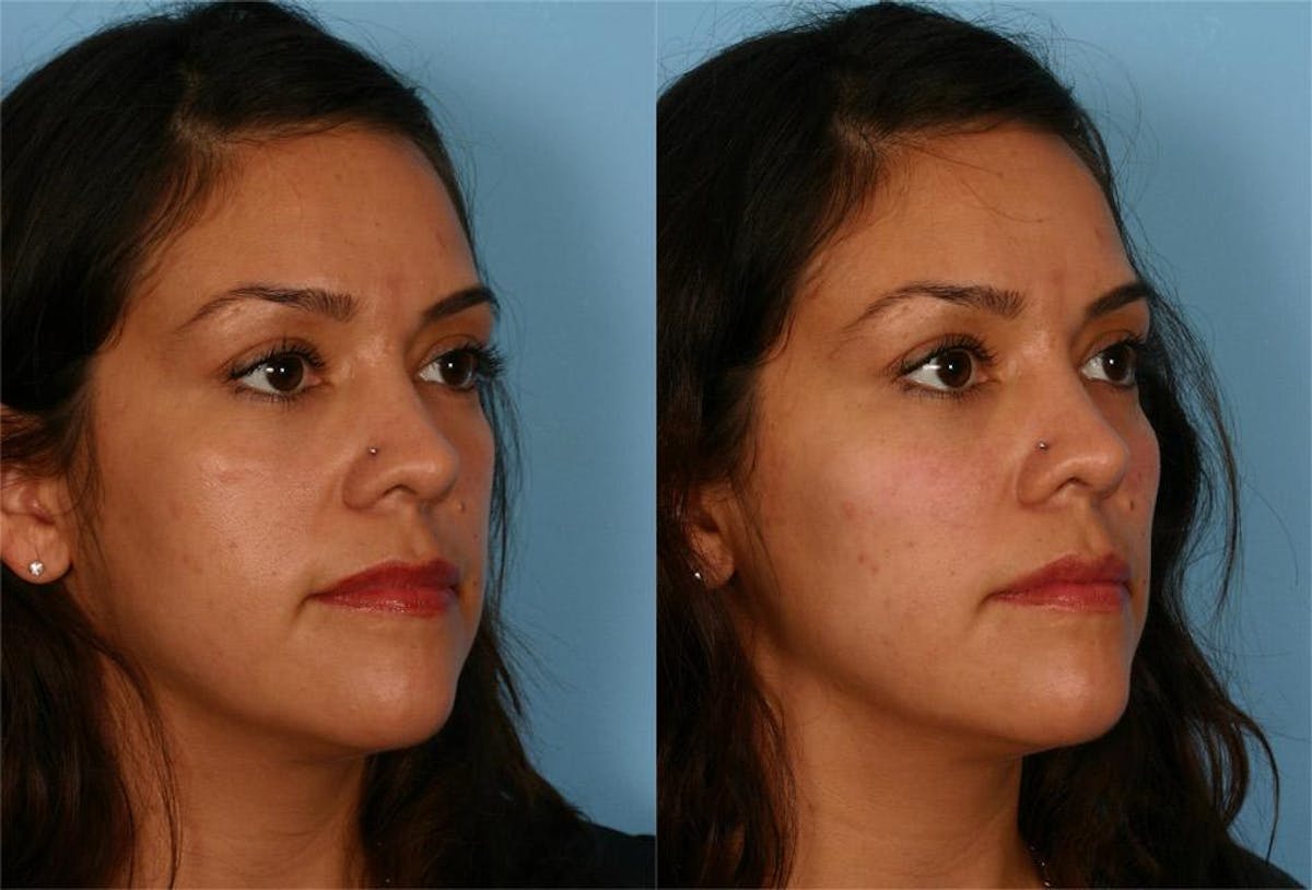 Chin and Cheek Augmentation Before & After Gallery - Patient 687329 - Image 2