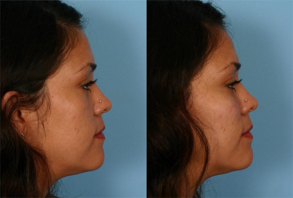 Chin and Cheek Augmentation Before & After Gallery - Patient 687329 - Image 3