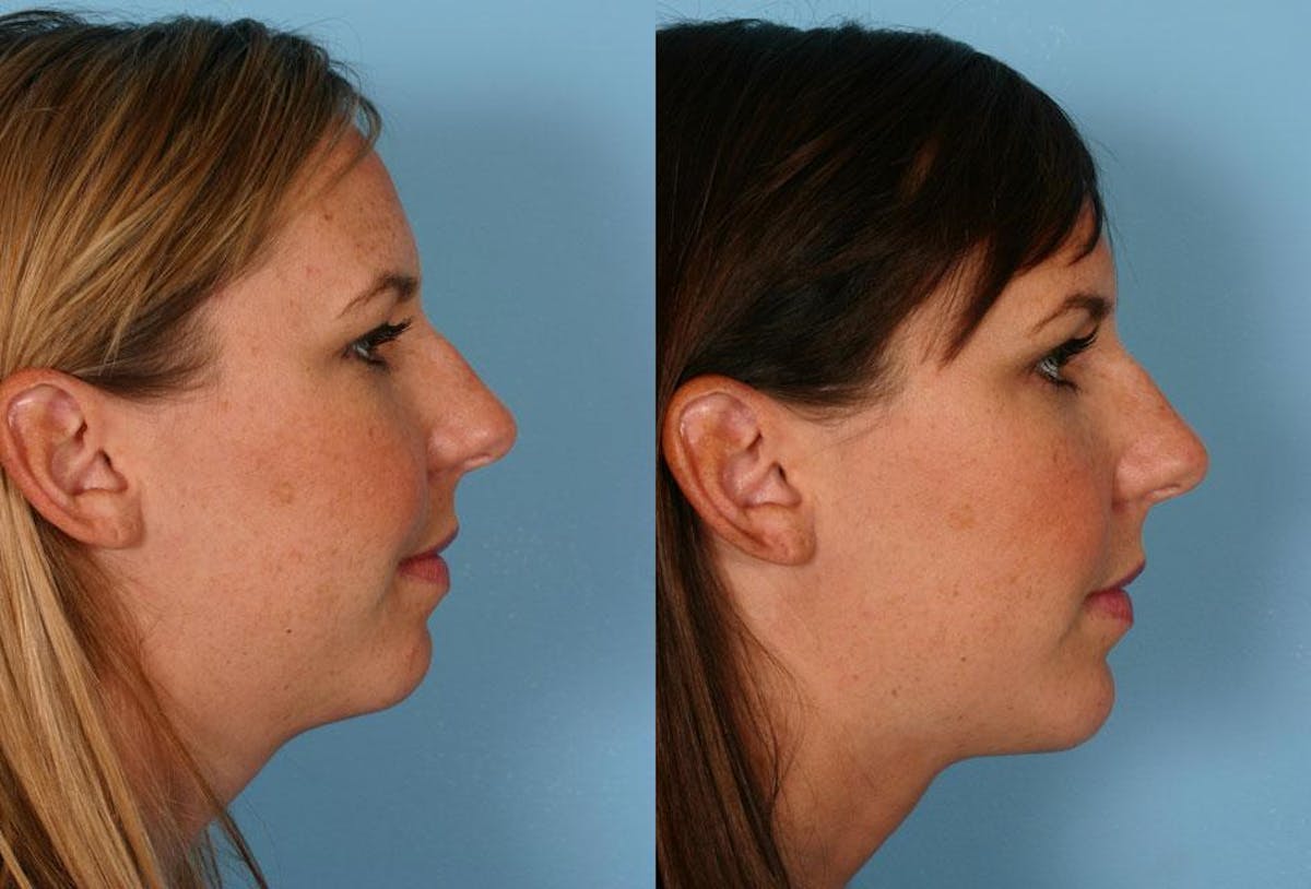 Chin and Cheek Augmentation Before & After Gallery - Patient 172182 - Image 1