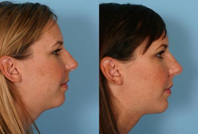 Chin and Cheek Augmentation Before & After Gallery - Patient 172182 - Image 1