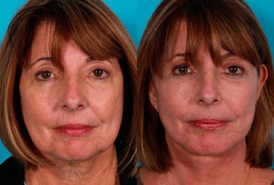 Chin and Cheek Augmentation Before & After Gallery - Patient 342992 - Image 1