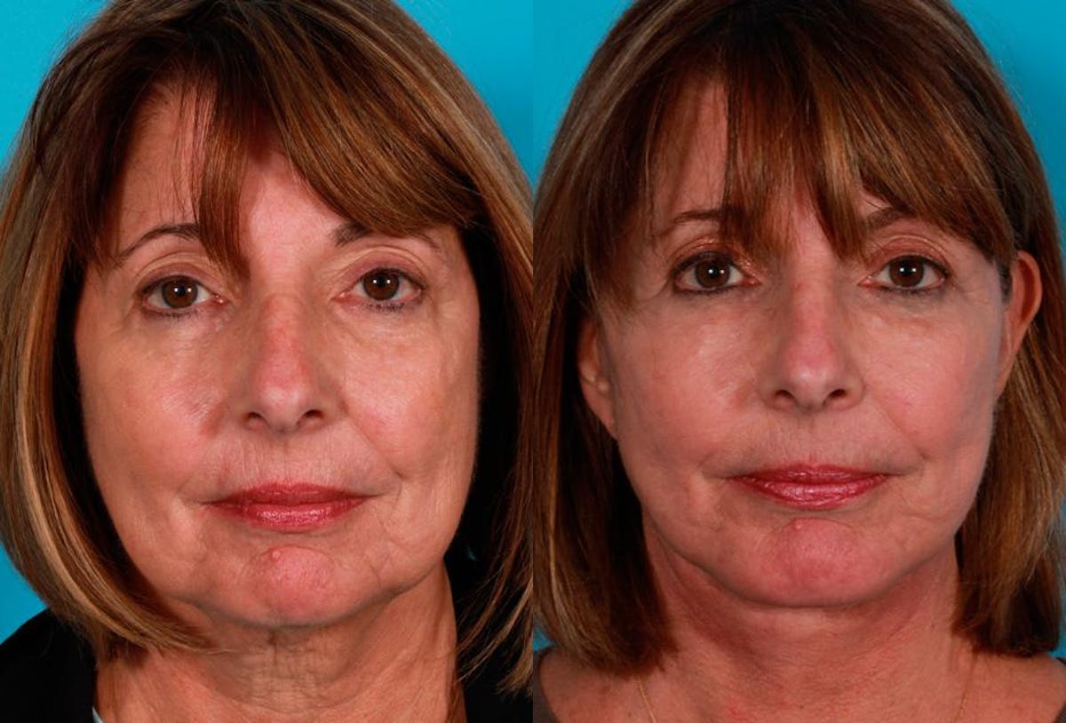 Chin and Cheek Augmentation Before & After Gallery - Patient 342992 - Image 1