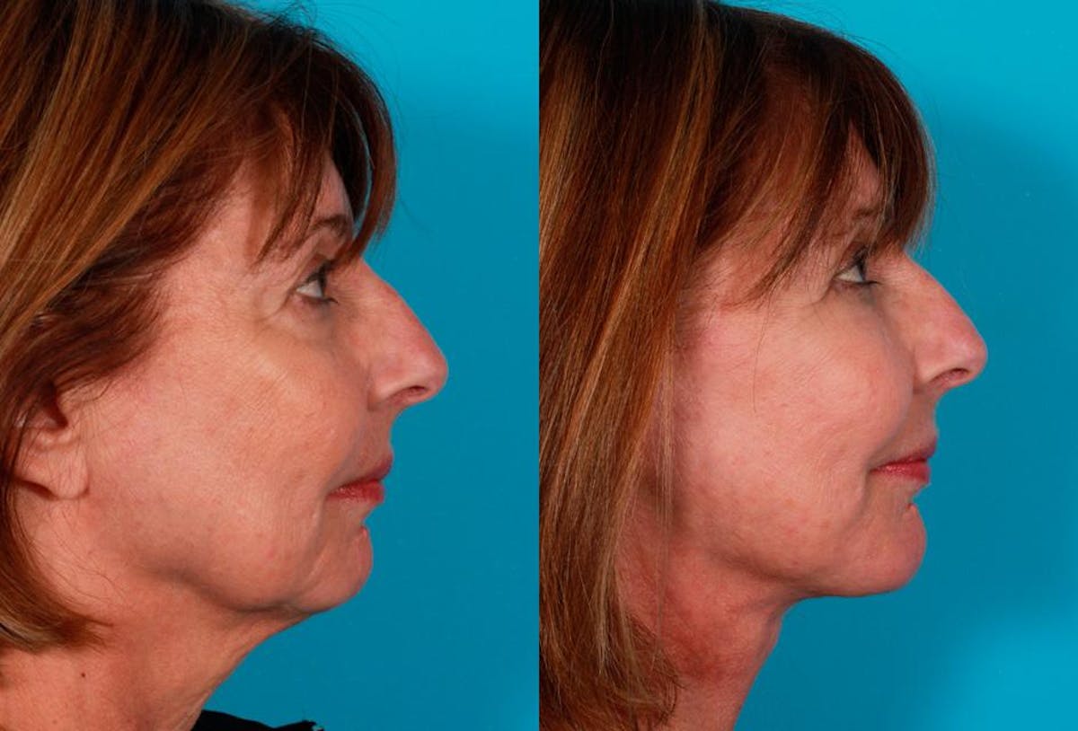 Chin and Cheek Augmentation Before & After Gallery - Patient 342992 - Image 2