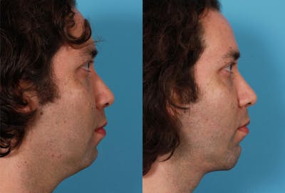 Chin and Cheek Augmentation Before & After Gallery - Patient 195093 - Image 1