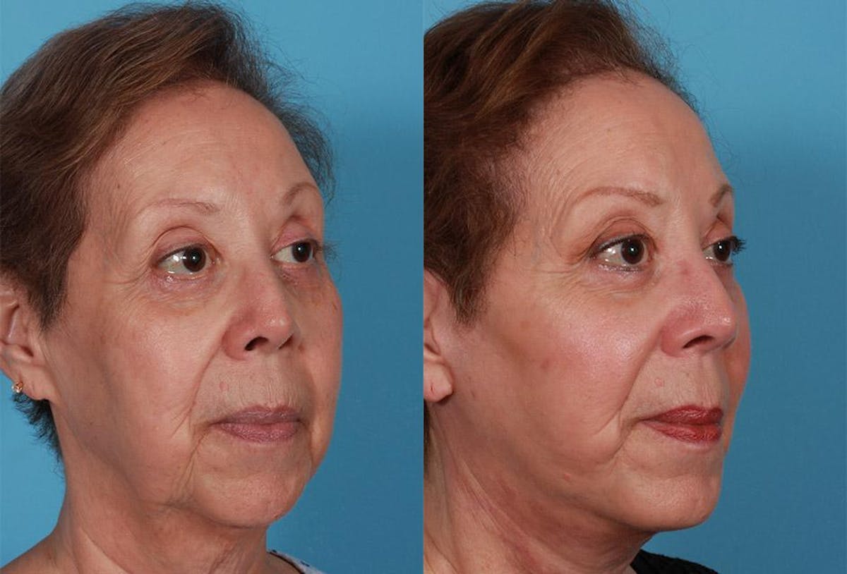 Chin and Cheek Augmentation Before & After Gallery - Patient 204951 - Image 2
