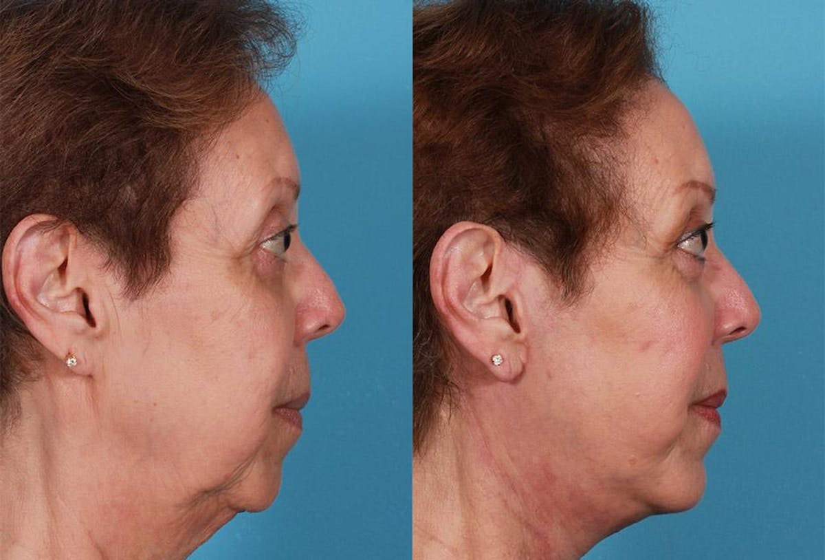 Chin and Cheek Augmentation Before & After Gallery - Patient 204951 - Image 3