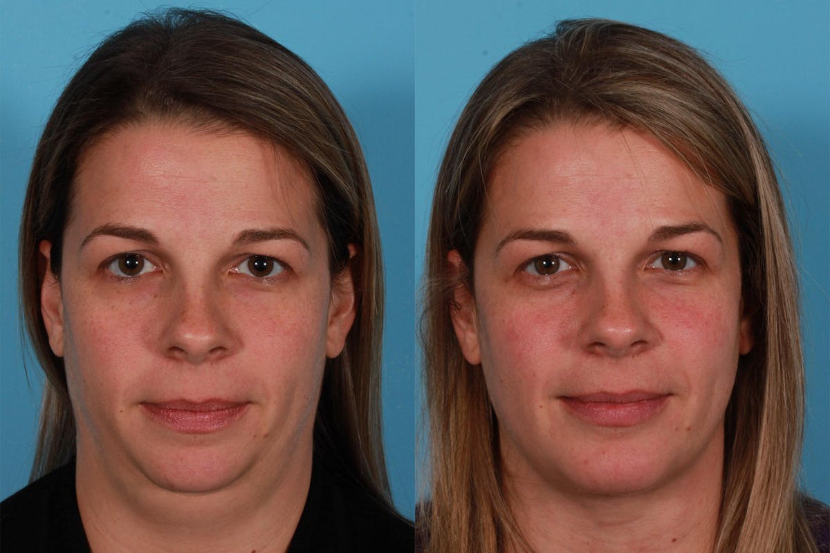 Chin and Cheek Augmentation Before & After Gallery - Patient 402023 - Image 1